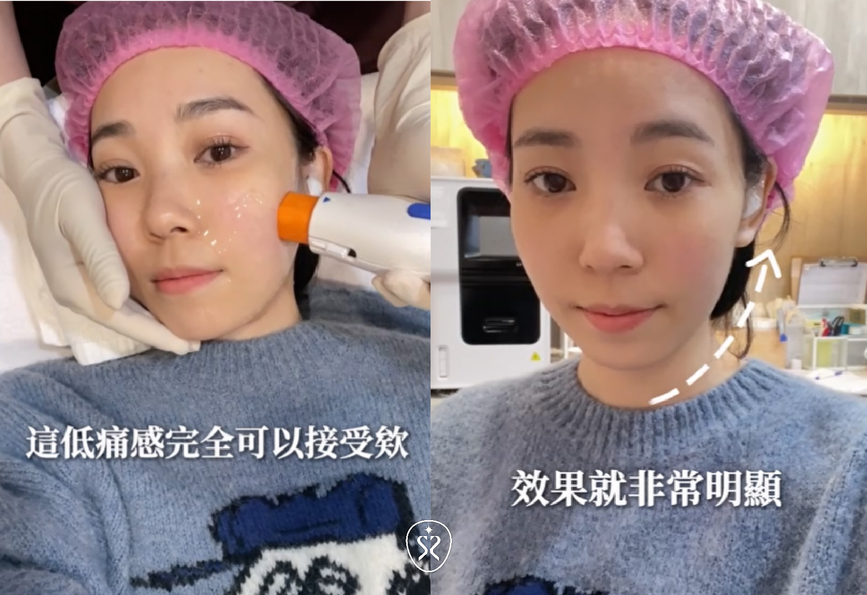 玩美電波有優化過後的冷卻系統讓施作的不適感降低很多